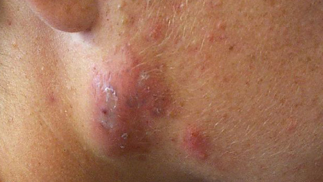 How to get rid of cysts?