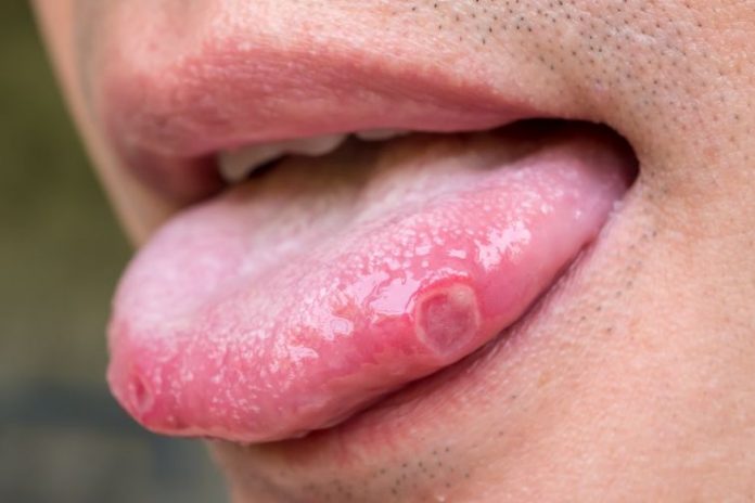 How to get rid of ulcers?